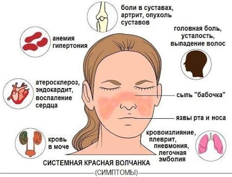 Основные симптомы системной красной волчанки