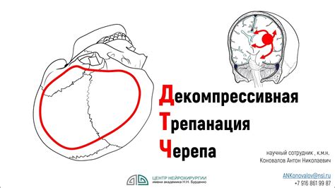 Особенности выхода из искусственной комы после трепанации черепа