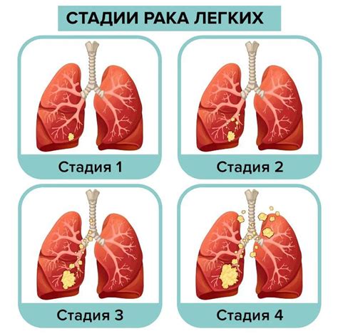 Первый этап лечения: диагностика и стадии рака легких