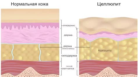 Питание и целлюлит: что есть, чтобы победить
