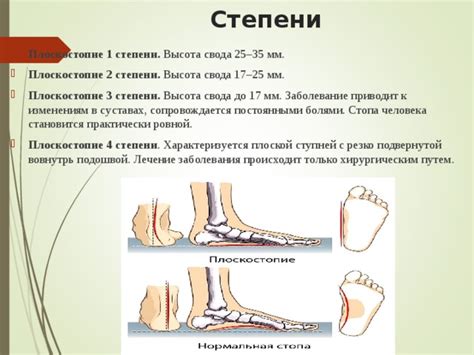 Плоскостопие и физкультура: освобождение и допуск