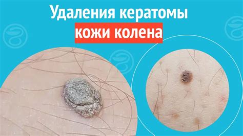 Плюсы и минусы удаления кератомы