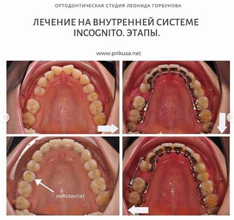 Повлияет ли установка брекетов на температуру организма?