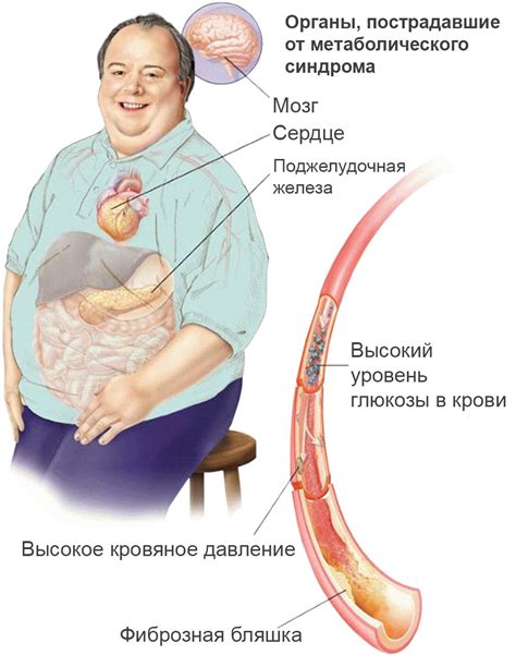 Повышение риска развития метаболического синдрома