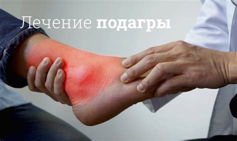 Подагра: что это и чем опасна