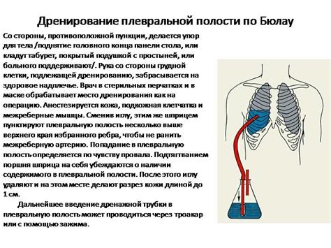 Показания для проведения дренажа легких