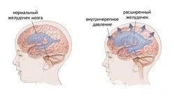 Помощь при повышенном внутричерепном давлении и высокой температуре