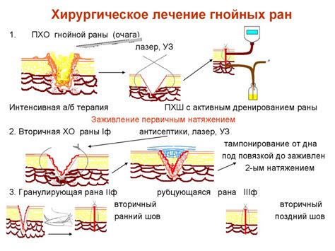 Последствия выдавливания гноя из раны