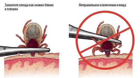 Последствия неправильного удаления клеща