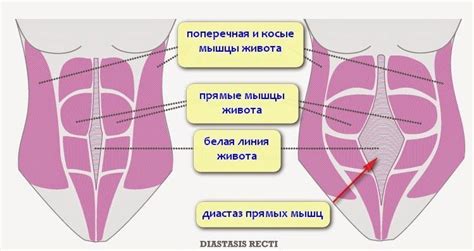 Почему важно исправить диастаз после родов?