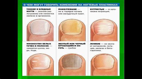 Почему возникают проблемы с врастающими ногтями?