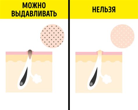 Предотвращение возникновения сальных нитей в будущем