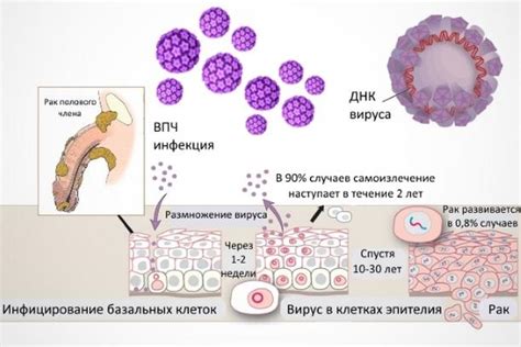 Причины возникновения ВПЧ у мужчин