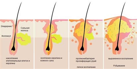 Причины и последствия лопнувшего фолликула 28 мм