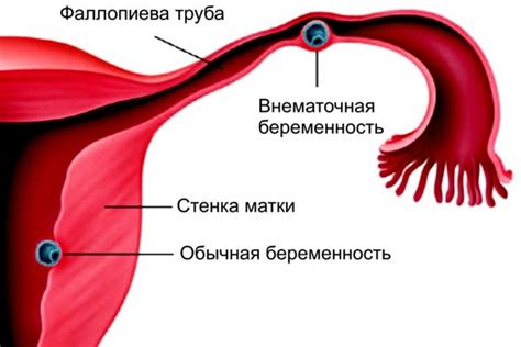 Профилактика внематочной беременности