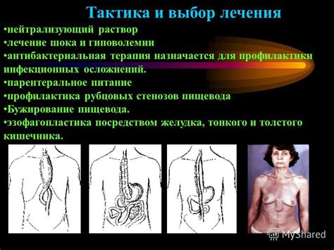 Профилактика обжигания пищевода горячим чаем