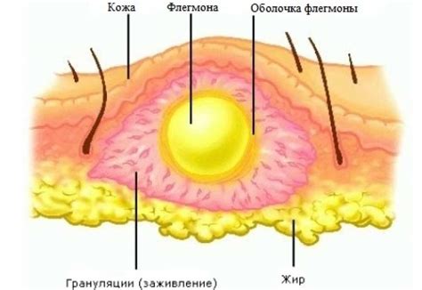 Профилактика опухоли в подмышке