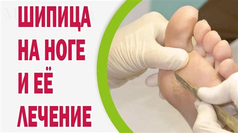 Профилактика шипицы на ногах: лучшие практики