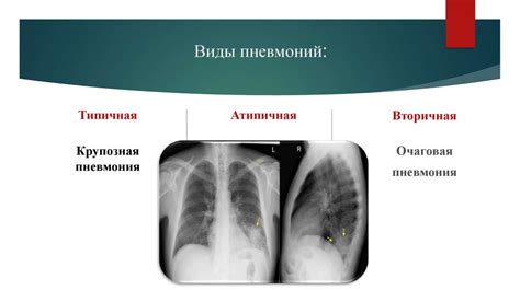 Рентгенография в диагностике пневмонии