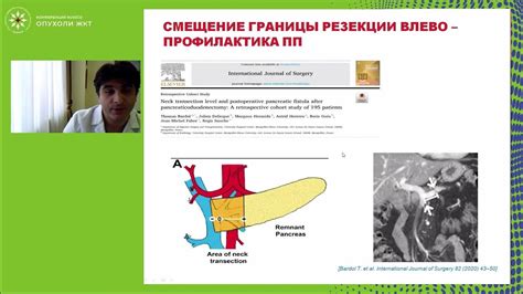 Риски и осложнения после резекции