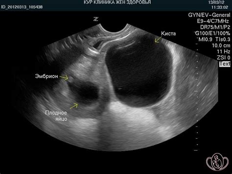 Роль эко в лечении фолликулярной кисты