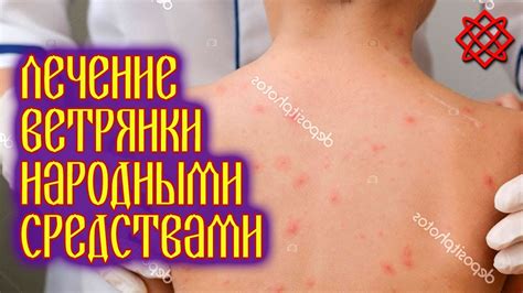 Симптомы ветрянки у взрослых