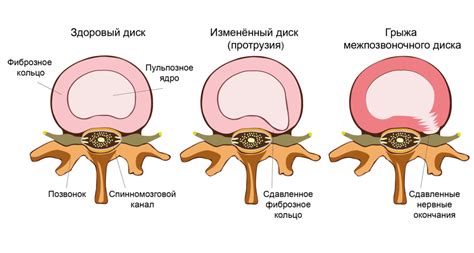 Симптомы грыжи на позвоночнике