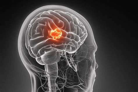 Симптомы и признаки доброкачественной опухоли головного мозга