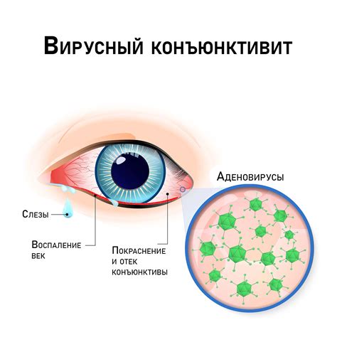 Симптомы конъюнктивита