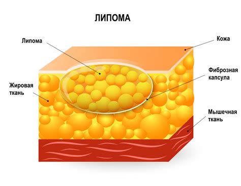 Симптомы липомы на руке