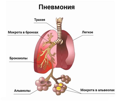 Симптомы пневмонии, вызванной вирусной инфекцией: