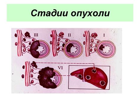 Стадии рака: понимание масштаба проблемы