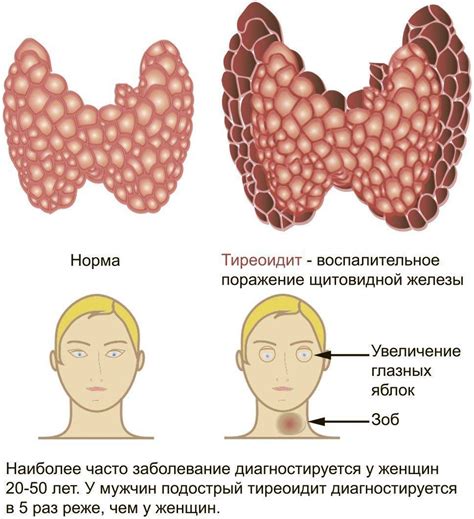 Тиреотоксикоз и питание