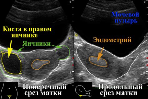 УЗИ органов малого таза