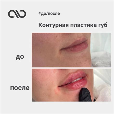 Увеличение губ: домашние средства и проверенные методики