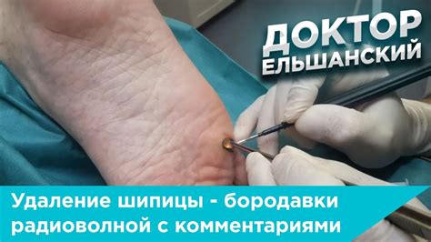 Удаление шипицы с пальца с использованием иглы