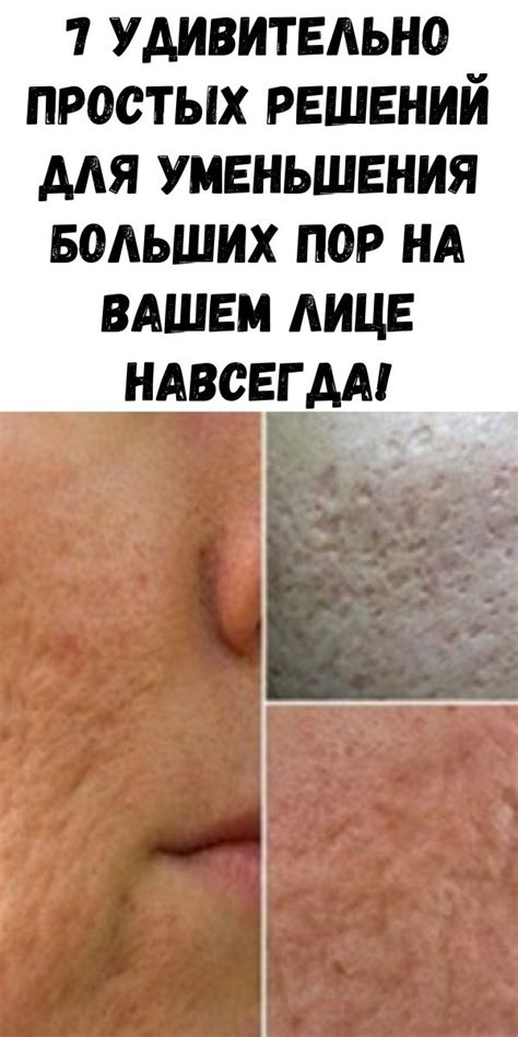 Уменьшение выраженности пор