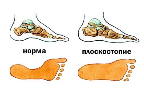 Физкультура и плоскостопие: правила допуска к занятиям