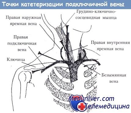 Хондроз – причина повышения давления?