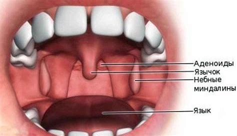 Что такое аденоиды и почему они требуют особого ухода
