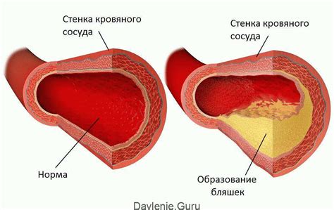 Что такое бляшки в сосудах