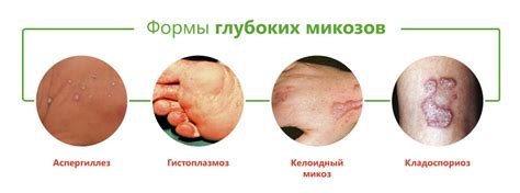 Что такое грибковые инфекции и как они воздействуют на кожу человека