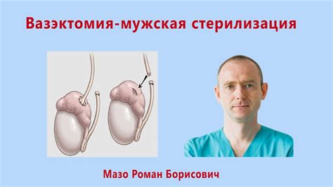 Что такое мужская стерилизация?