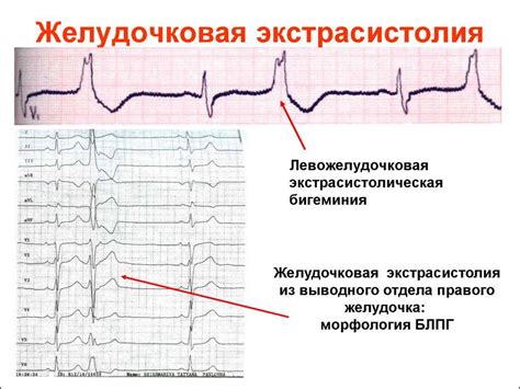 Экстрасистолия и ее влияние на работу сердца